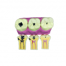 Tooth Decay Evolution Model